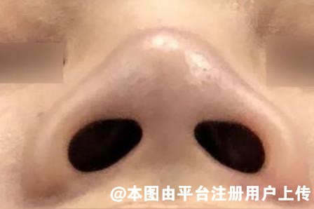 鼻子好不好看对整体颜值的影响还是比较大 鼻翼肥大该如何改善呢