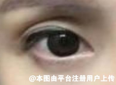 同样是做双眼皮 为什么你的术后为什么出现瘢痕呢