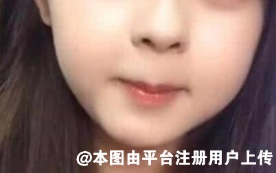 婴儿肥多少岁会消失？脸颊有肉是面部吸脂还是祛颊脂垫