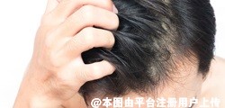 近7成脱发人士都在30岁以下 真正的脱发需要达到什么样标准