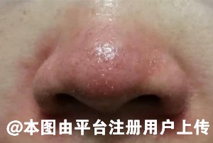 由于酒糟鼻导致鼻子大 应该去医美还是去整形