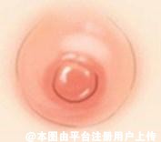 乳晕过大难以启齿且不美观  乳晕缩小术是怎做的呢