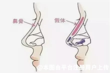 整形知识：医生告诉你什么情况下需取出隆鼻假体