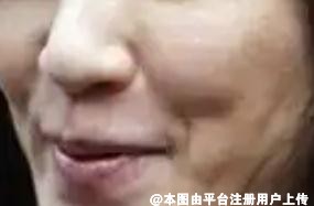 变老无法抵抗  但我们可以通过医美手段来延缓它的到来