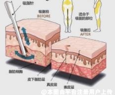 水动力吸脂术后失败修复前要再次注意这些问题