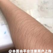 毛手毛脚的女孩子该怎么选择脱毛方式呢