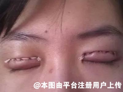 不要再说男生割双眼皮会显得娘了 这样的双眼皮更显阳刚之美