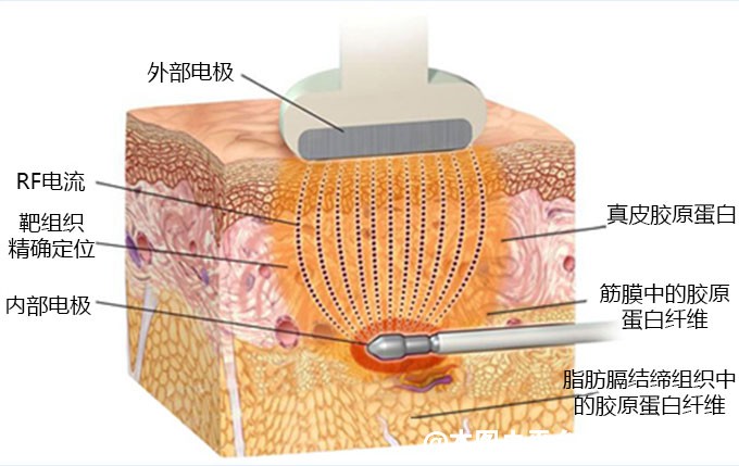 黄金微雕有什么效果 它与吸脂的有什么区别