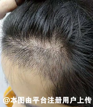 植发也分男女有别 为何女士比男士植发便宜这么多