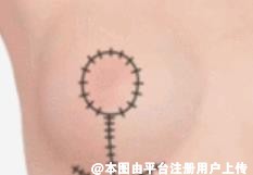 乳房整形：乳晕又大又黑有什么方法改善