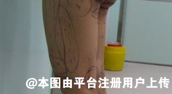 做完大腿吸脂过程是怎么样的？术后如何正确护理