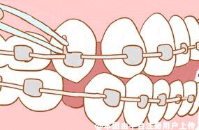 这里有你​牙齿正畸之前的你担心的问题