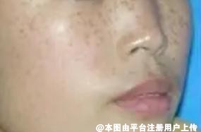 脸部的斑是女性的天敌 如何才能消除脸部的斑呢