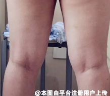 大腿吸脂后腿出现凹凸不平怎么改善呢