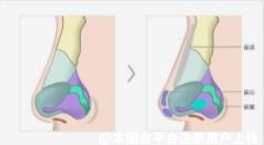 这几种隆鼻材料哪种更持久稳定