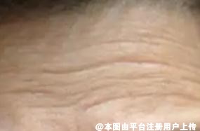 拿什么来拯救抬头纹 玻尿酸除皱怎么样呢