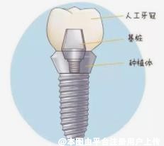 种植牙美观舒适寿命也长，但不是所有人都能做种植牙