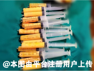 大腿和腰腹部的脂肪填充全脸 哪个成活率高