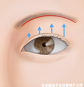 上眼睑松弛选择做双眼皮还是提眉  要看眼周整体的松弛情况