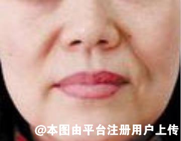 热玛吉是很好的除皱方式 如何辨别热玛吉仪器真伪呢