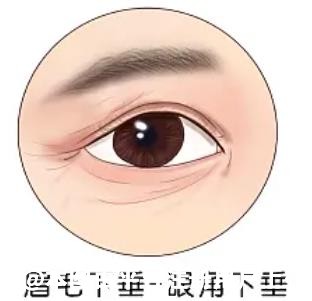 35岁眼角下垂做切眉还是双眼皮比较合适