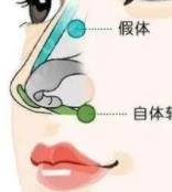 鼻修复后这2个问题是无法给出准确答案的