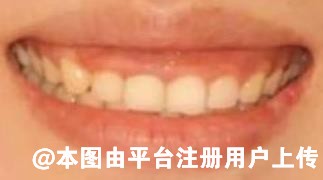 想要预防牙龈萎缩 需要多注意这几个方面