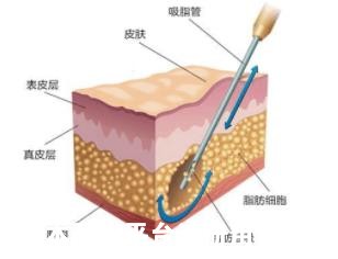 为什么吸脂后皮肤不会变松反而变得更紧致