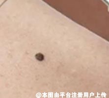 色素痣没那么可怕 早知道早解决