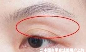 上睑凹陷影响眼睛神态 既然是凹陷那可以填充脂肪矫正吗