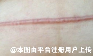 剖腹产疤痕增生恢复一年多刀口处还有红色突出物该用什么医美方式去除