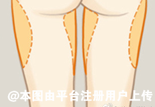 大腿吸脂会不会有副作用