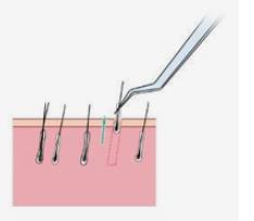 雍禾植发医生：雍禾医院植发的FUE技术加密能解决毛发稀疏的问题