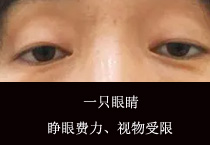 35岁的她一只眼睛睁眼费力、视物受限 割了双眼皮居然好了